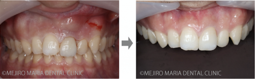 目白マリア歯科_【症例】前歯のセラミック修復による審美的な回復（前歯部１歯補綴）_術前術後の比較写真